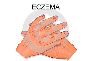 Hands of a patient suffering from eczema