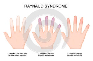 Hands of a person with Raynaud`s phenomenon from white color when blood flow is restricted to blue and red when blood flow return