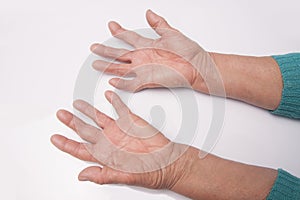 Hands With Rheumatoid Arthritis