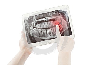 Hands showing pain on teeth radiology or radiography and pc tablet