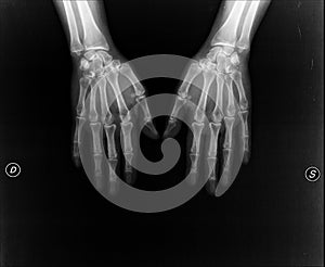 Hands under X-ray