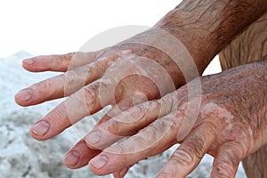 Hands with vitiligo skin condition