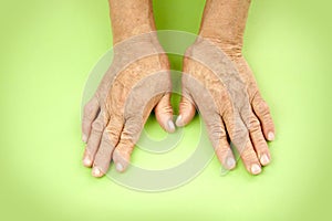 Hands Of Woman Deformed From Rheumatoid Arthritis