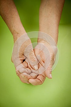 Hands Of Woman Deformed From Rheumatoid Arthritis