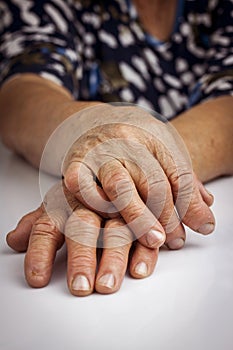 Hands Of Woman Deformed From Rheumatoid Arthritis