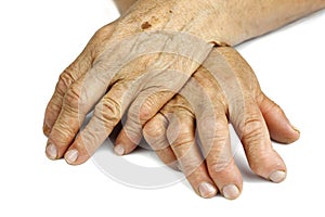 Hands Of Woman Deformed From Rheumatoid Arthritis photo