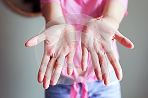 Hands woman with rash or papule and scratchon palm on from allergies,Health allergy skin care problem