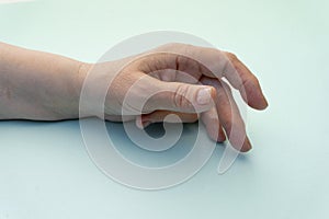 Hands of a woman with twisted fingers. Dupuytren`s contracture disease photo