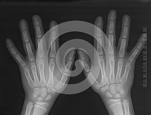 Hands x-ray photo