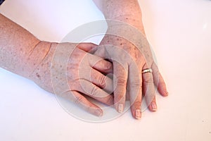 The hands of a 58 year old woman with mild artritis. photo