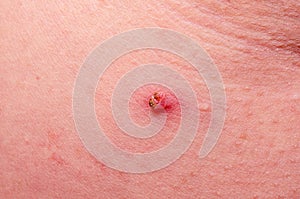 Hanging nevus under the armpit on human skin