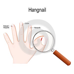 Hangnails. Vector diagram for medical use photo