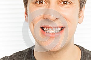 Happy face of young man with dental braces photo