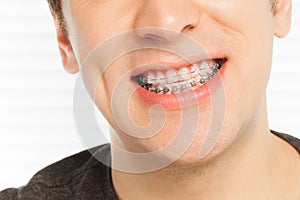 Happy man`s smile with orthodontic cases photo