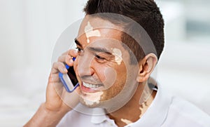 happy man with vitiligo on face calling on phone