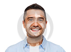 Happy smiling man with vitiligo photo