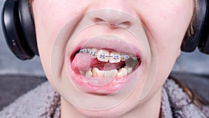 Happy smiling teenage girl with dental braces. Orthodontic treatment