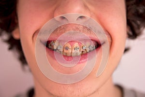 Happy teen with braces,Orthodontics