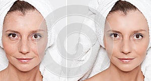 happy woman after beauty treatment - before/after shots - skin care, anti-aging procedures, rejuvenation, lifting, tightening of