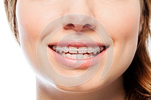 Happy woman`s smile with orthodontic clear braces