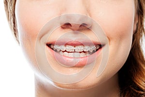 Happy woman`s smile with orthodontic clear braces photo