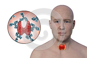 Hashimoto's thyroiditis, conceptual 3D illustration