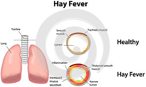 Hay fever
