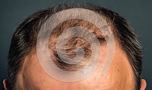The head of a balding man, the idea of hair transplantation is a surgical method, generated by AI