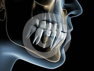 Head and jaw with a dental implant photo