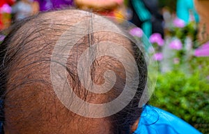 Head lose hair.Close up of head Asian man less hair. Glabrous