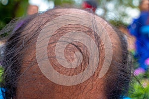 Head lose hair.Close up of head Asian man less hair. Glabrous ,