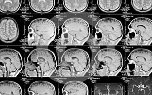 Head magnetic resonance image