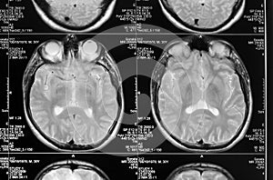 Head magnetic resonance image