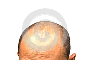 Head of man lose one`s hair, glabrous on his head