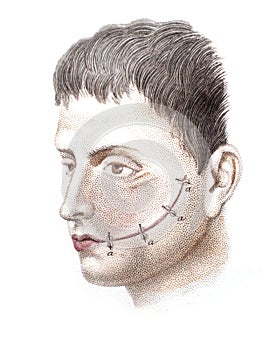 The head of a man with a surgical suture on his cheek in the old book The Human Body, by K. Bock, 1870, St. Petersburg