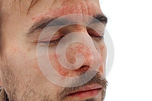 Head of sick man with closed eyes with red allergic reaction on facial skin, redness and peeling psoriasis on nose, forehead and photo
