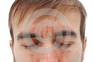 Head of sick man with closed eyes with red allergic reaction on skin, redness and peeling psoriasis on nose, forehead and cheeks,