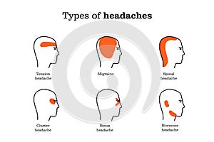 Headache location by type infographic