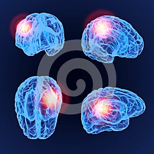 Headache X-Ray 3D model. Brain neurons synapse, anatomy body. Set of medical illustration of disease, head pain