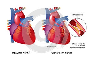 Healhty and unhealthy heart