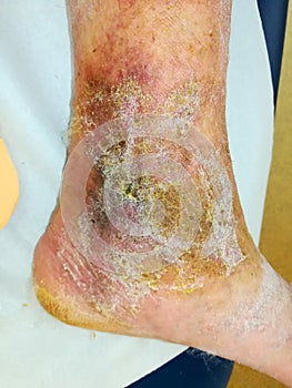 Healing leg ulcer photo