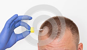 Healing oil for scalp hair restoration. Hair follicle restoration, close-up. Dihydrotestosterone