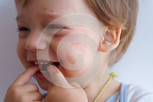 Health, dermatology, pediatrics, disease dermatitis concepts - close-up of face small baby child with sick dry skin rash