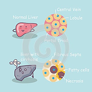 Health liver vs cirrhosis liver