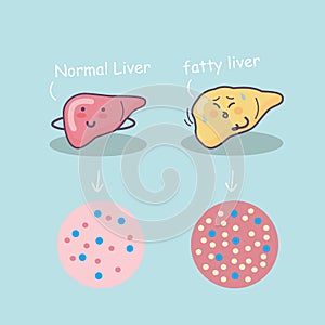 Health liver vs Fatty liver photo
