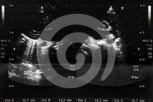 Health monitoring, close up. Echocardiography, ultrasound of the heart.