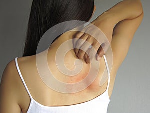 Health problem. woman scratching her itchy back with allergy rash photo