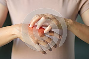 Healthcare and medical concept. Female scratching itch on her hand. photo