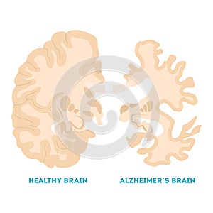 Healthy and alzheimer brain. Neurodegeneration concept illustration photo