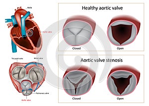 Healthy aortic valve or Aortic valve stenosis. Type of heart valve disease or valvular heart disease. photo